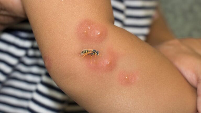 picadura_avispa